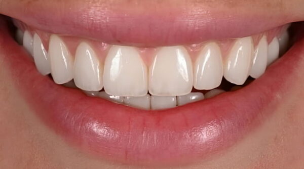 After - The Beresford Clinic